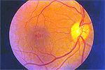 Macular Hole